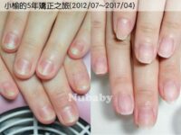 甲肉萎縮 - 小榆的5年指甲矯正之旅
