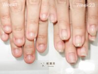 咬指甲 超短指甲矯正後做法式指甲
