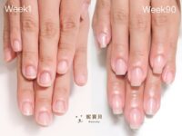 指甲保養 很重要 愛摳皮甲床短 矯正成功靠這個