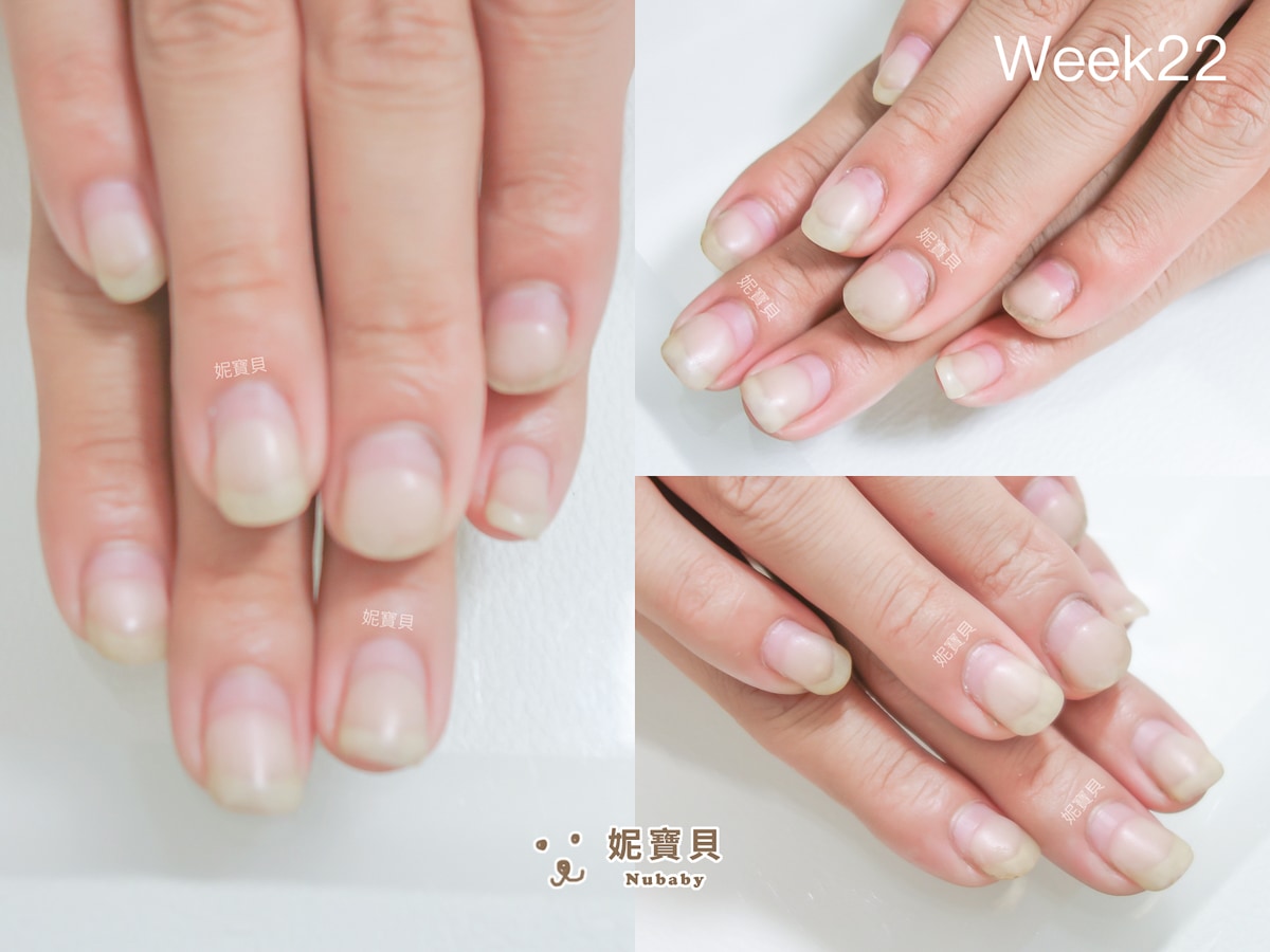 短指甲 矯正成健康指甲