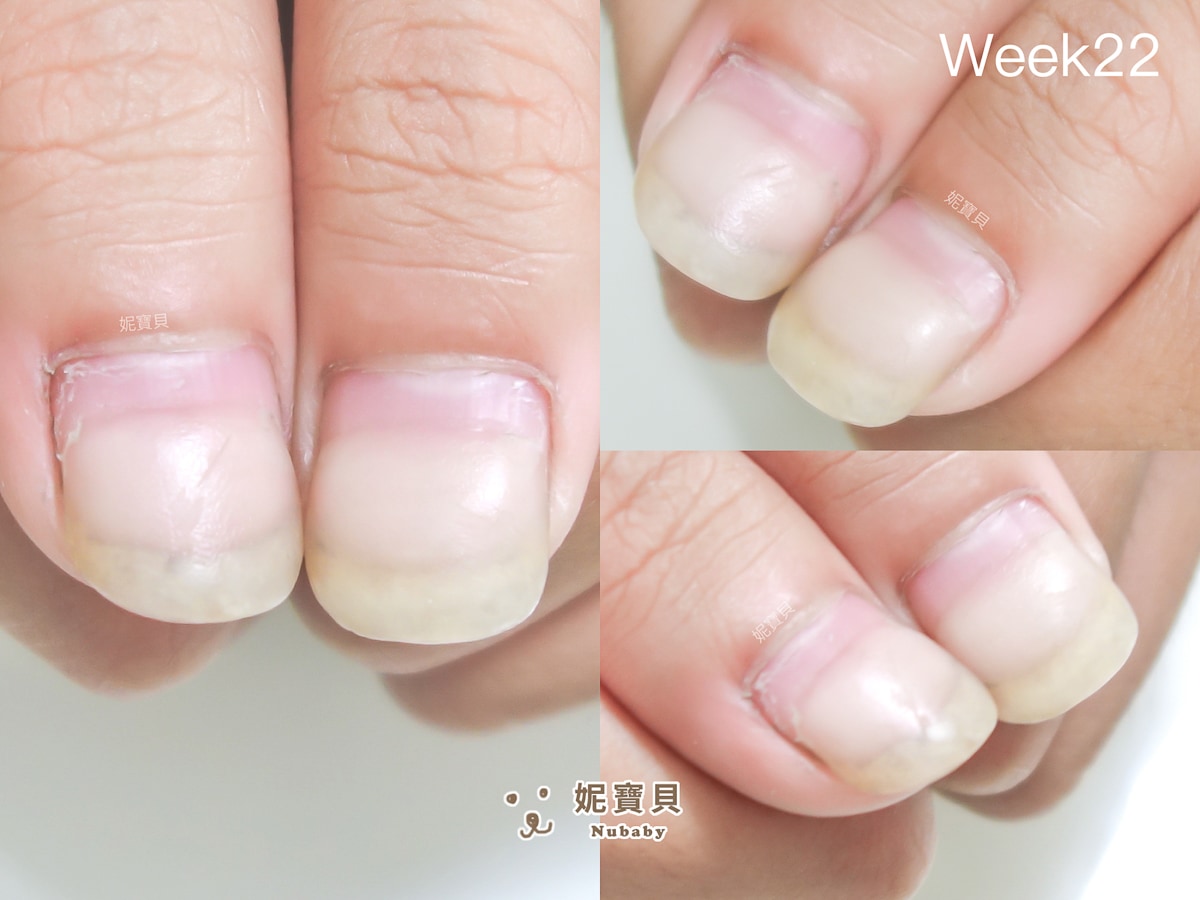 短指甲 矯正成健康指甲