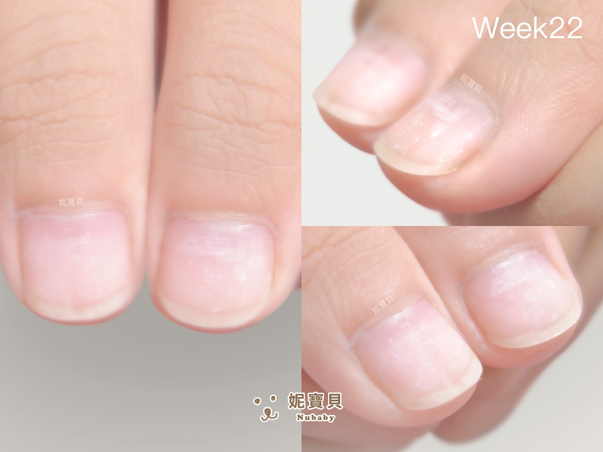 指甲凹陷 短指甲 矯正成健康指甲