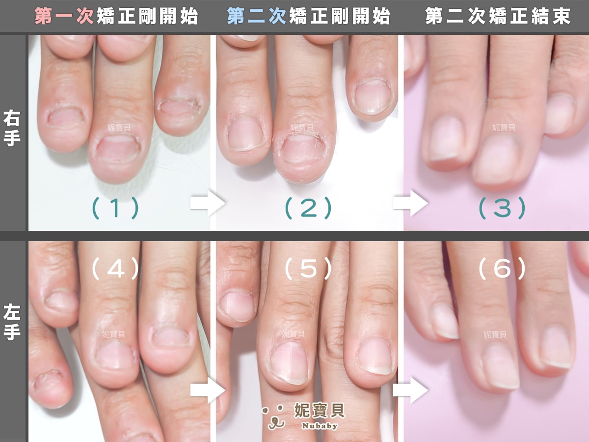 指甲凹陷 短指甲 矯正成健康指甲
