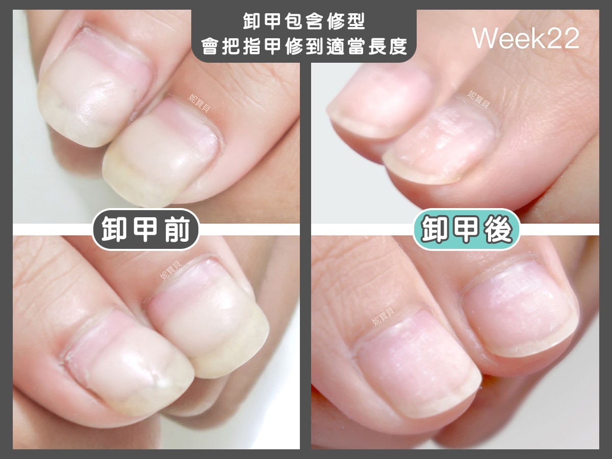 指甲凹陷 短指甲 矯正成健康指甲