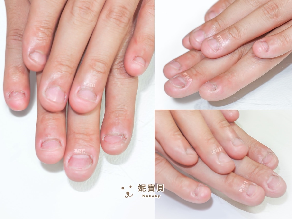 指甲凹陷 短指甲 矯正成健康指甲