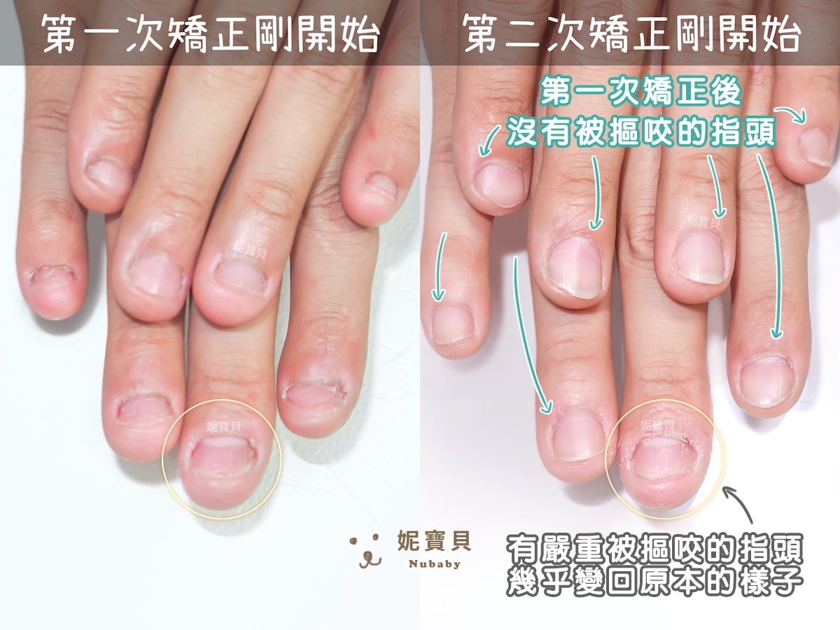 指甲凹陷 短指甲 矯正成健康指甲