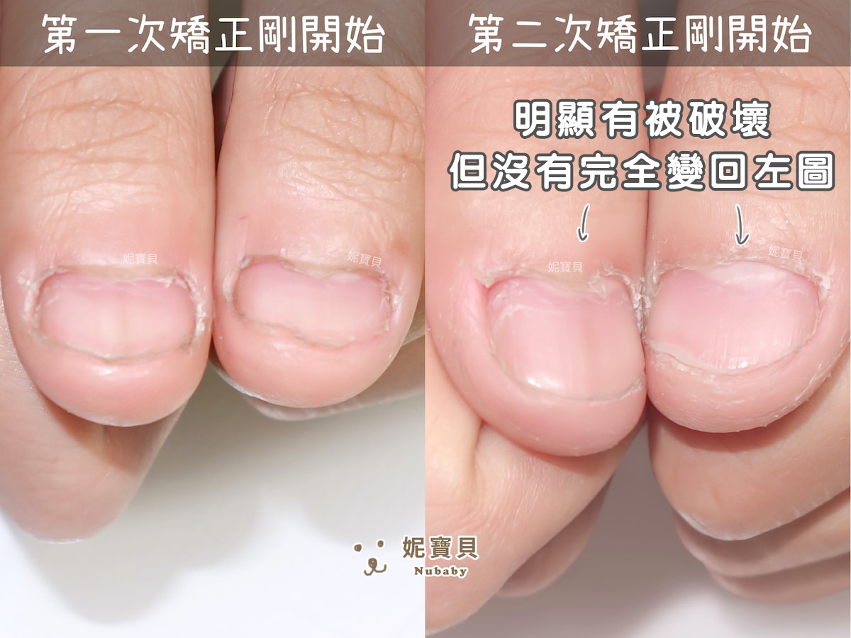指甲凹陷 短指甲 矯正成健康指甲