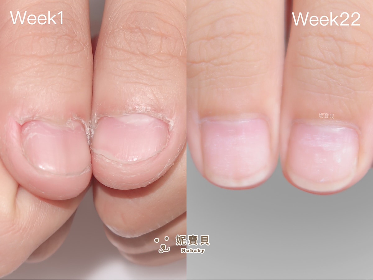 指甲凹陷 短指甲 矯正成健康指甲