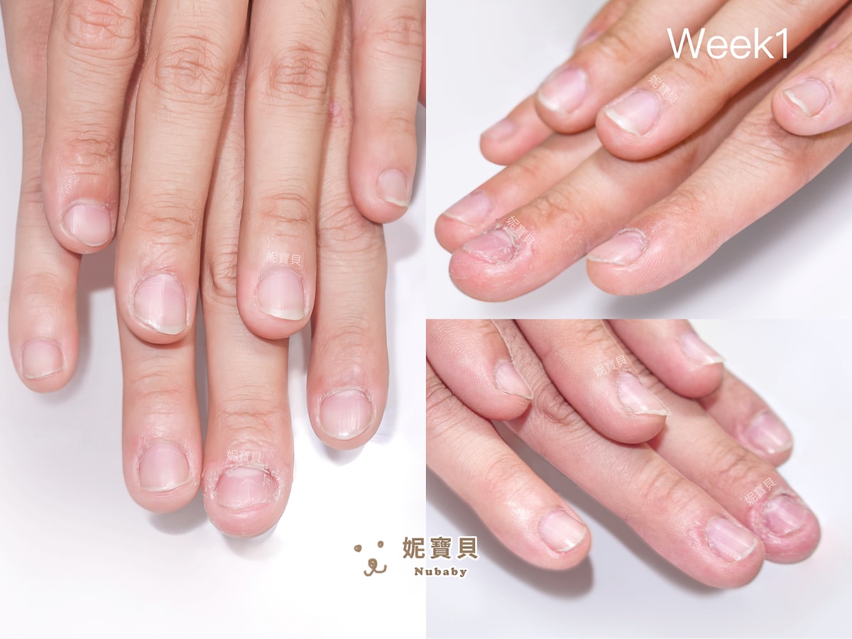 指甲凹陷 短指甲 矯正成健康指甲