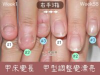 指甲快沒了 嚴重摳咬指甲 凝膠保護後指甲重長